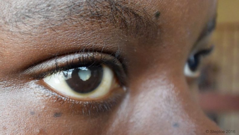 ebola-cataracts