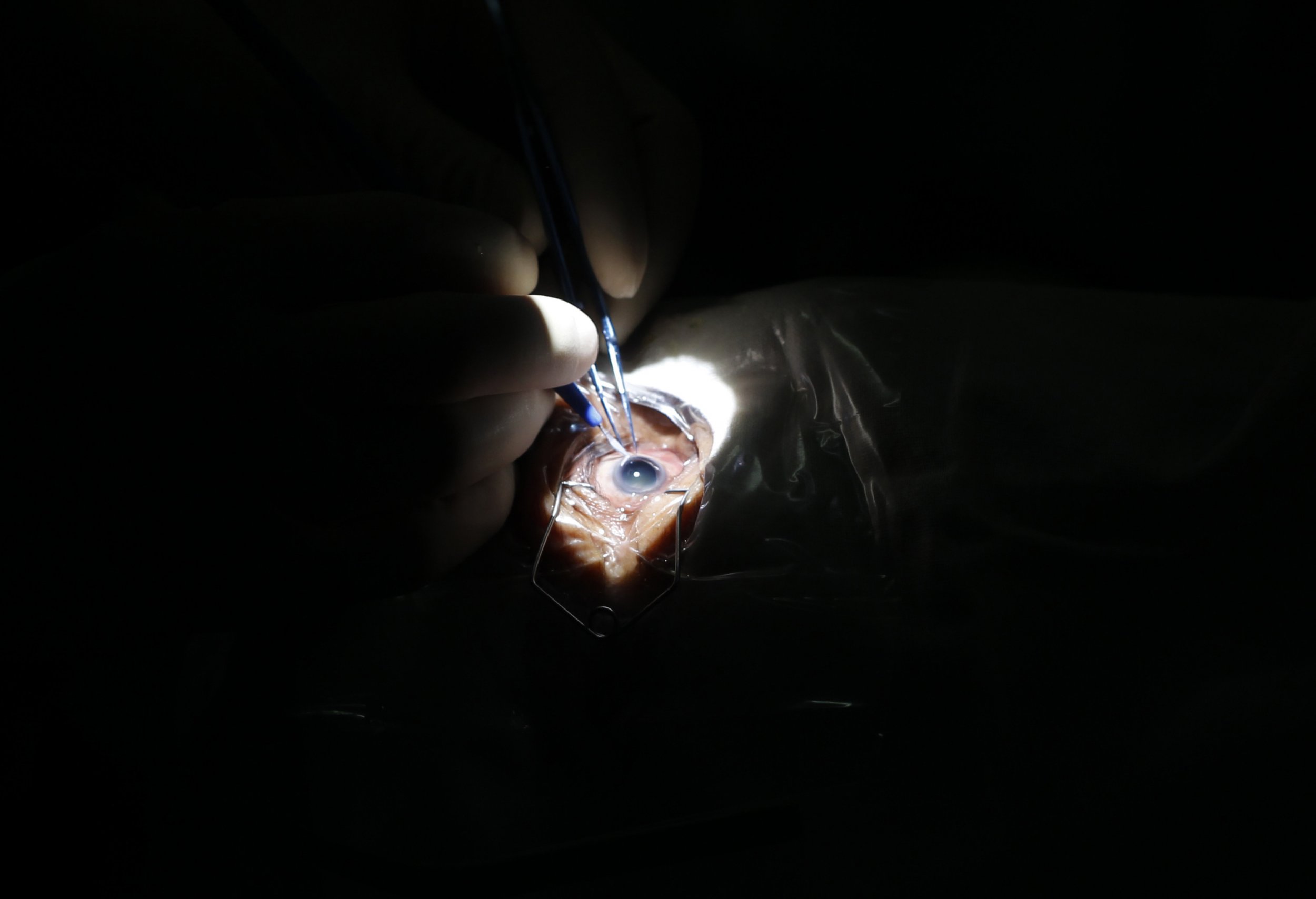 The Truth About Lasik Eye Surgery What Nobody Tells You Before Going Under The Laser