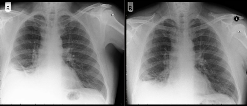 2017 cxr