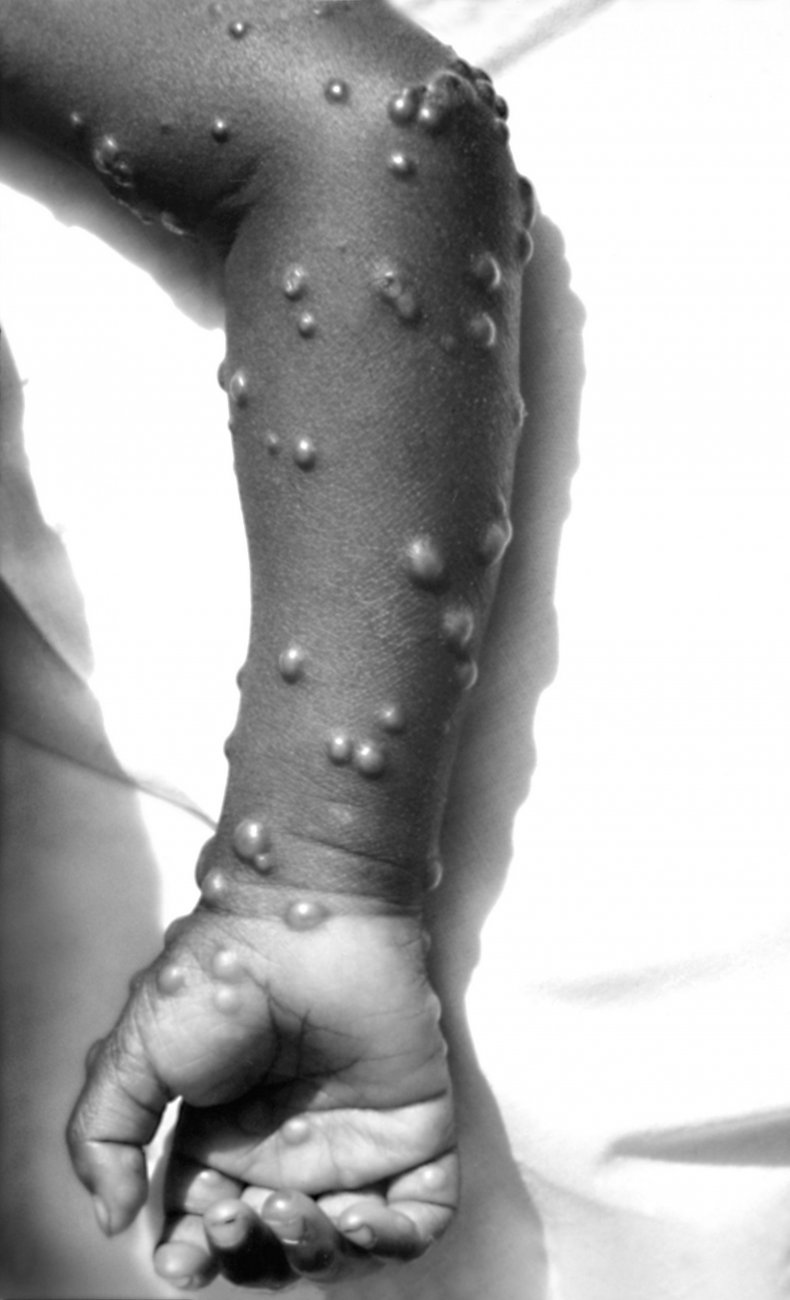 smallpox_example