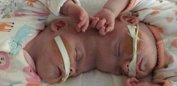 Twins Born With Heads Attached Defy Odds and Leave Hospital Five