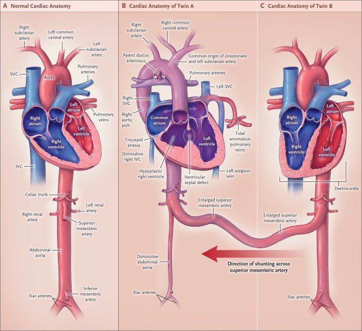 1026_conjoined_hheart 1026_conjoined_hheart