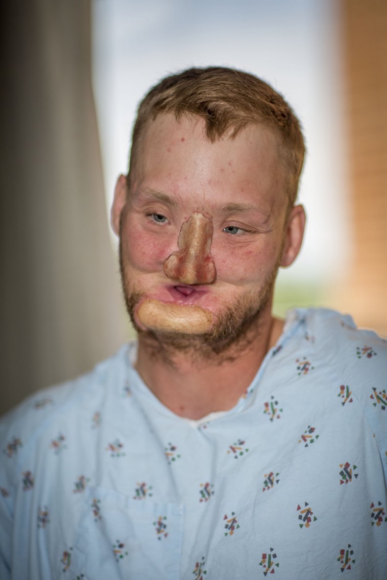 11_10_!7_FaceTransplant