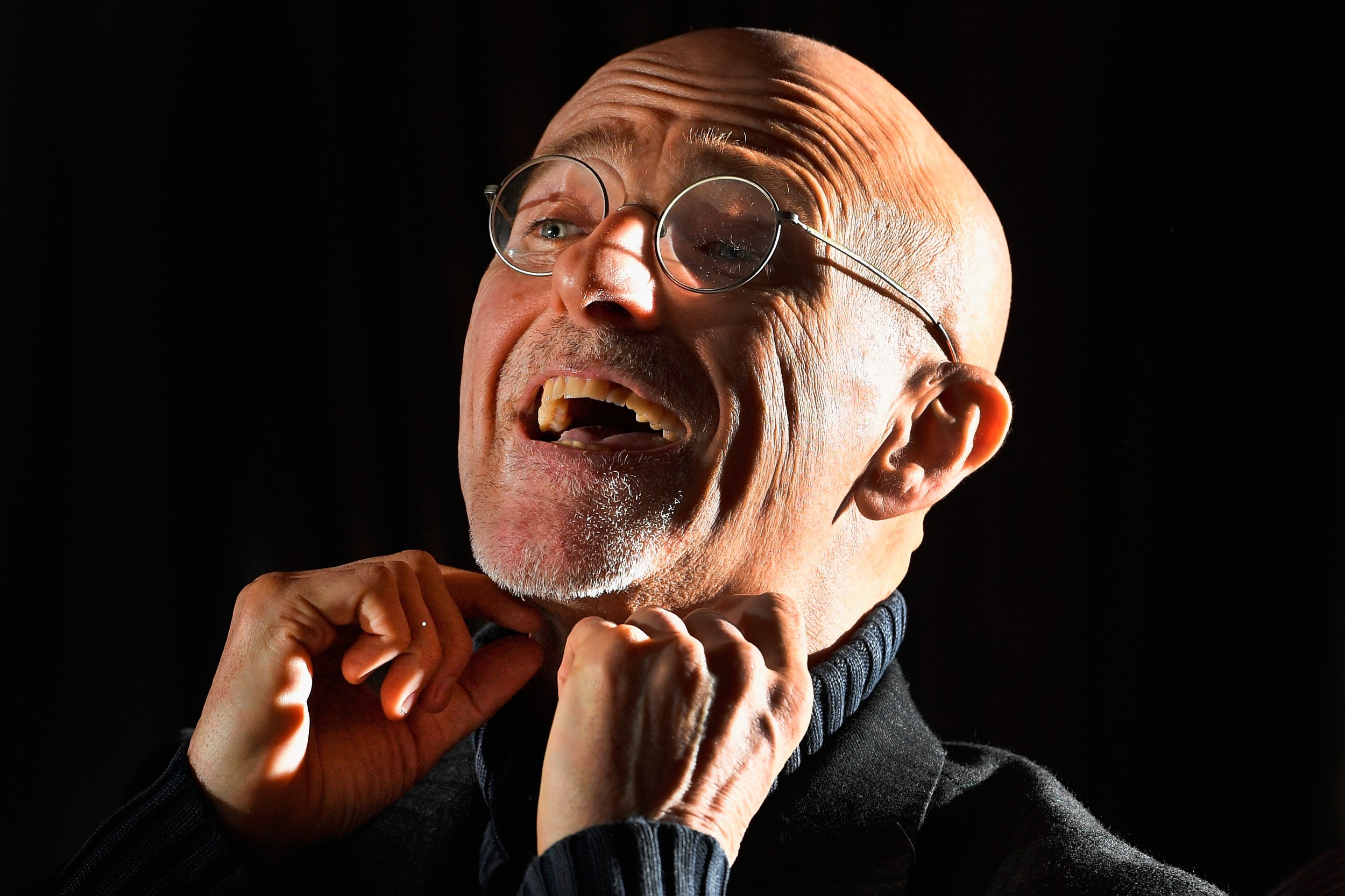 First Human Head Transplant Successfully Performed on Corpse, Sergio