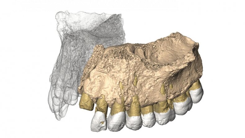 1_26_Jaw reconstruction
