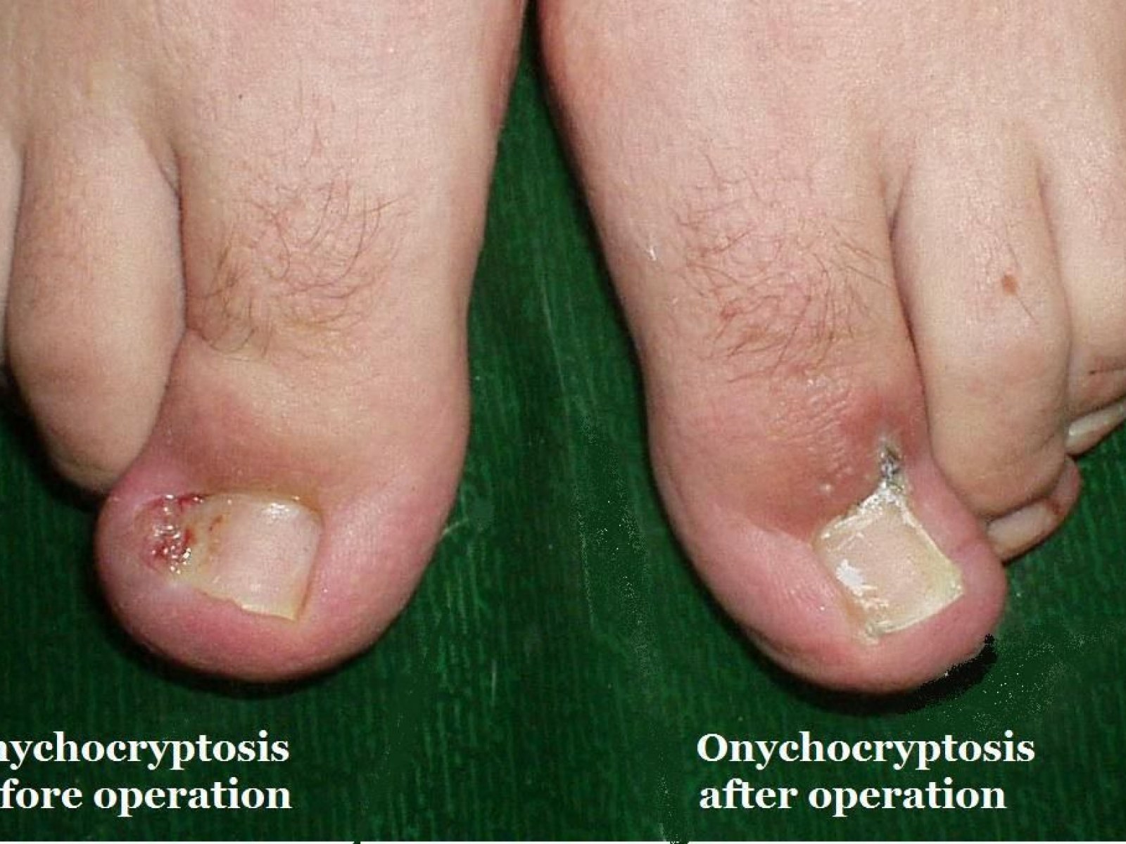 Thanks President Trump, You Have Cured My Ingrowing Toenail Thanks President Trump, You Have Cured My Ingrowing Toenail