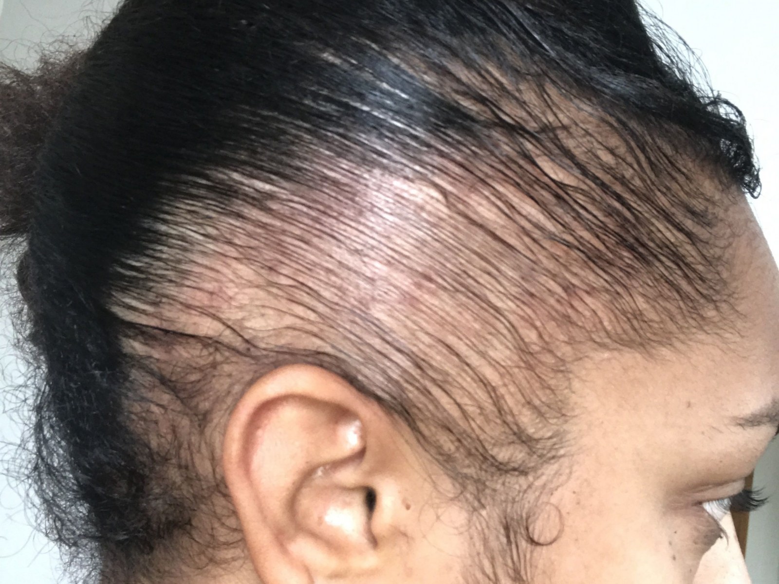 Traction Alopecia: Young Female Singer Warns of Self-inflicted Hair Loss—'Don't  Let It Happen to You'