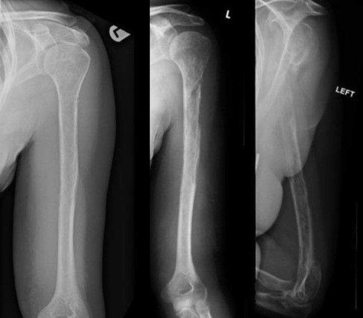 4_6_Arm bones X Rays 4_6_Arm bones X Rays