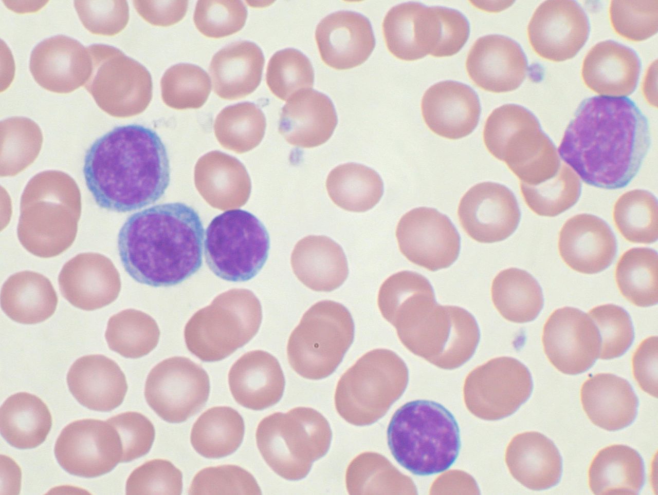 1280px-Chronic_lymphocytic_leukemia