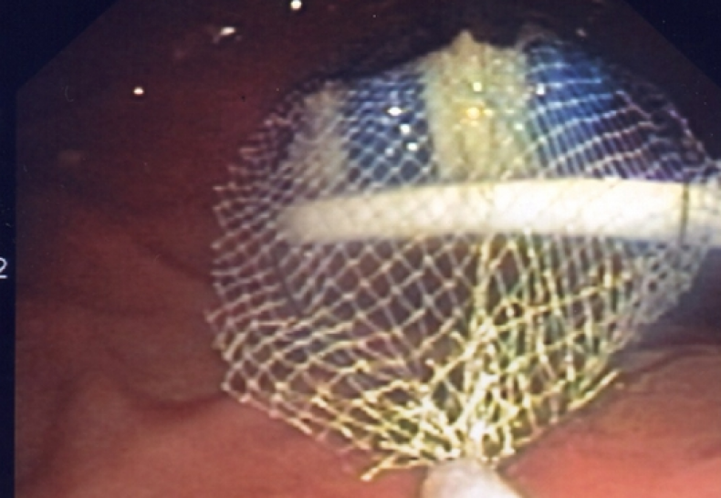 04_11_toothbrush endoscopy