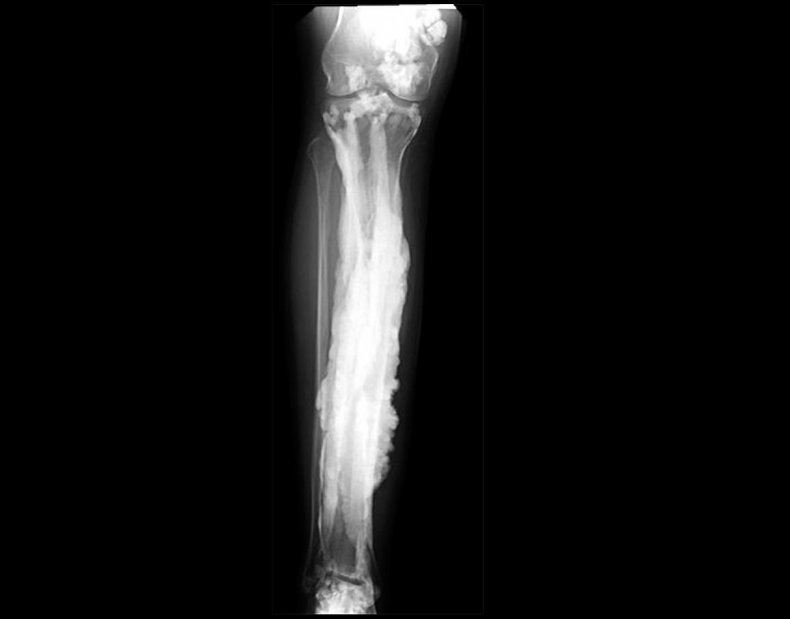 20180411-melorheostosis-of-the-leg