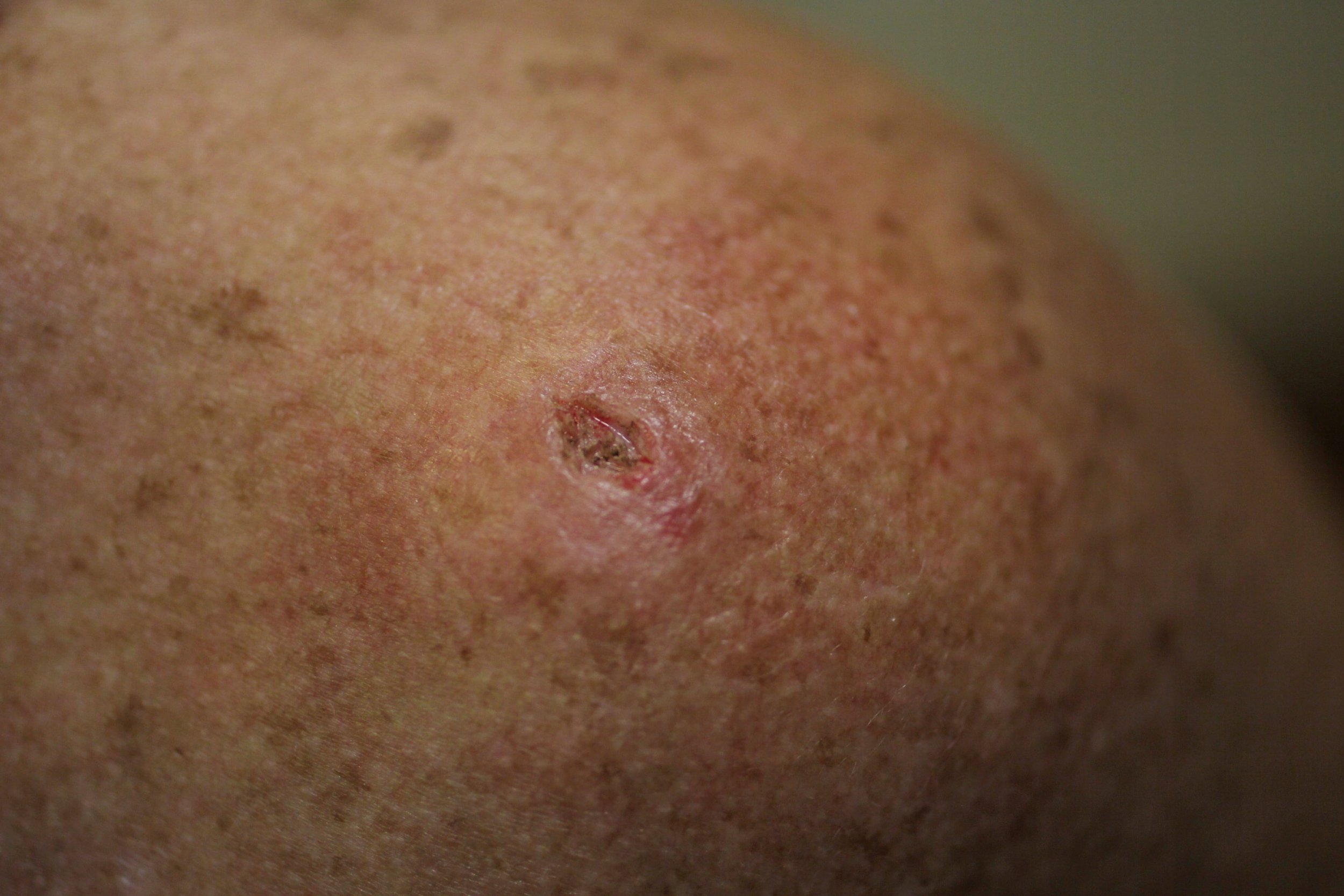 04/20/skin cancer