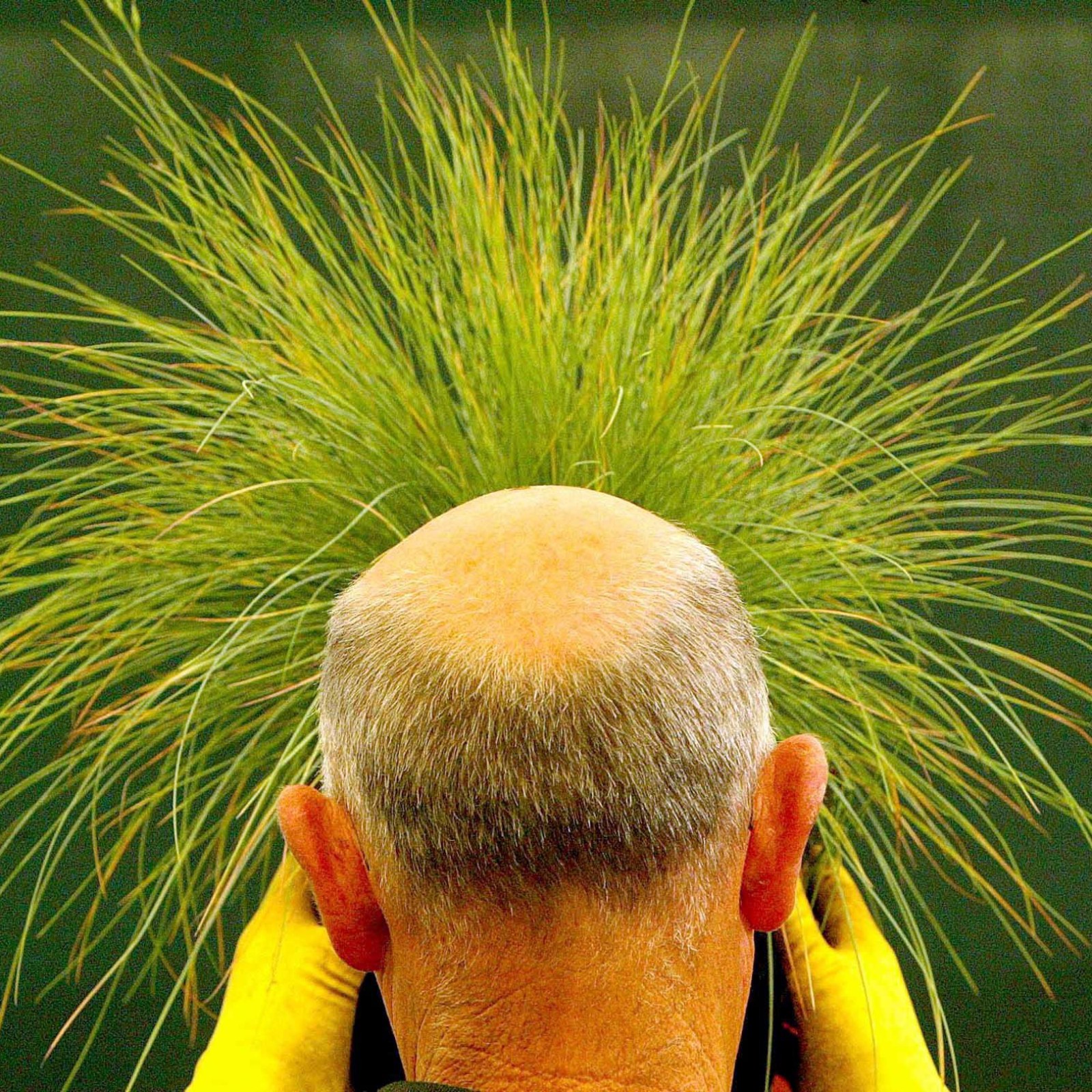 New Cure for Baldness Could Be Found in Existing Drug, Scientists Say