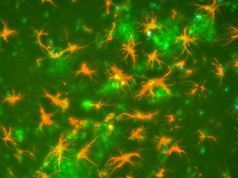 Glial Amyloid Plaques