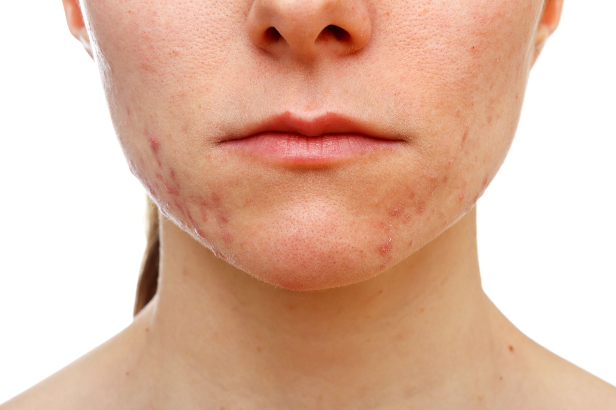 acne-skin-stock